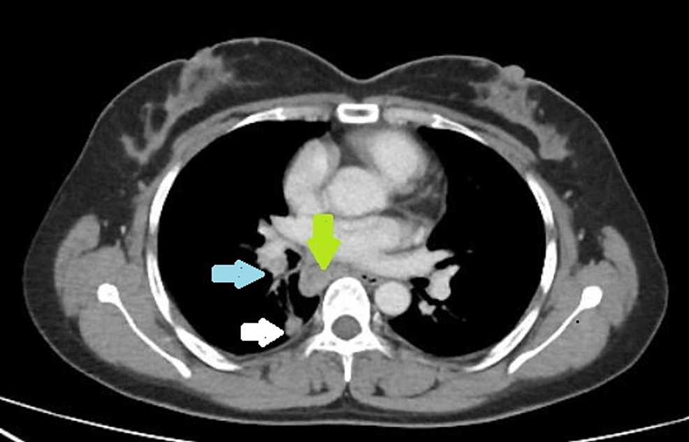 Cureus The Clinicopathological Features of Mediastinal Tuberculous