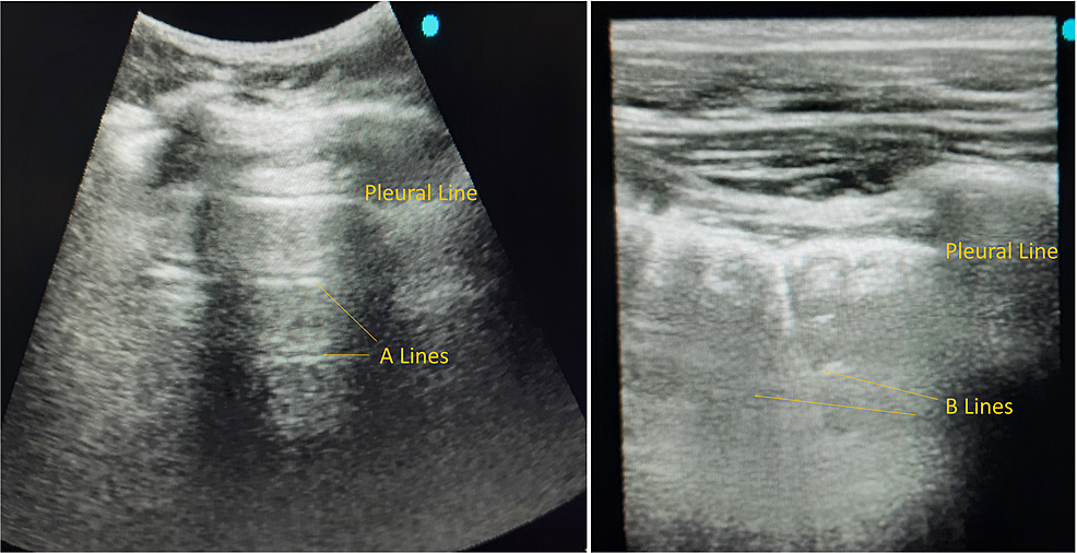 Cureus | Point-of-Care Thoracic Ultrasonography In Patients With ...