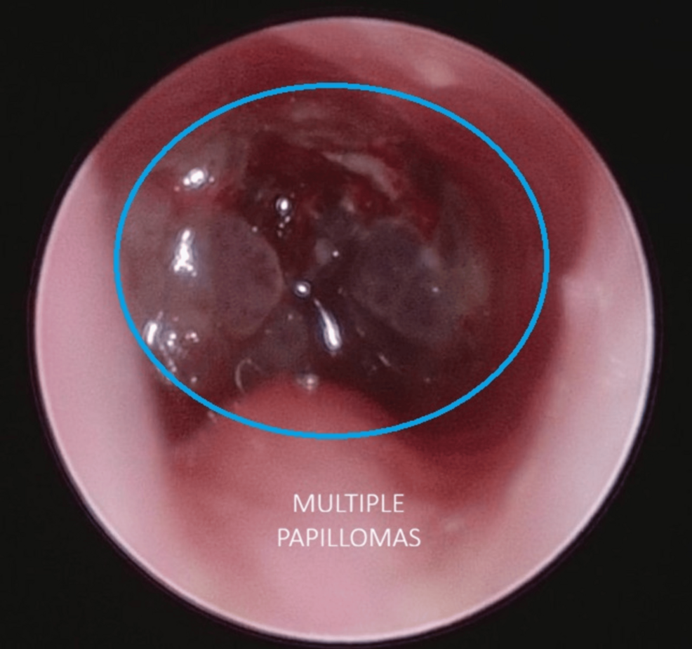 Endoscopic-view-demonstrating-extensive-papillomatous-lesions-involving-the-upper-tracheal-airway