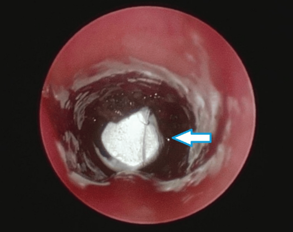 Endoscopic-view-of-the-tracheal-lumen-following-excision-of-upper-airway-papillomas-with-the-microlaryngeal-surgery-(MLS)-tube-cuff-in-situ.
