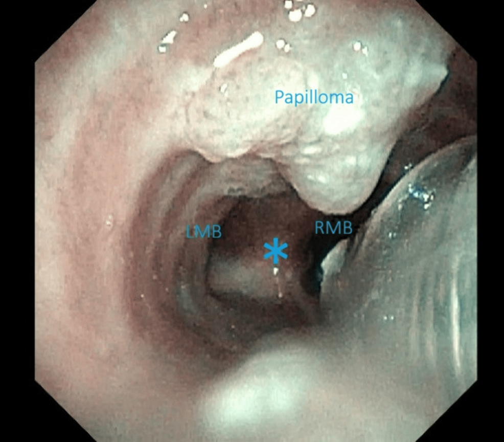 Endoscopic-view-demonstrating-distal-airway-papillomatous-lesions-in-the-region-of-the-carina.