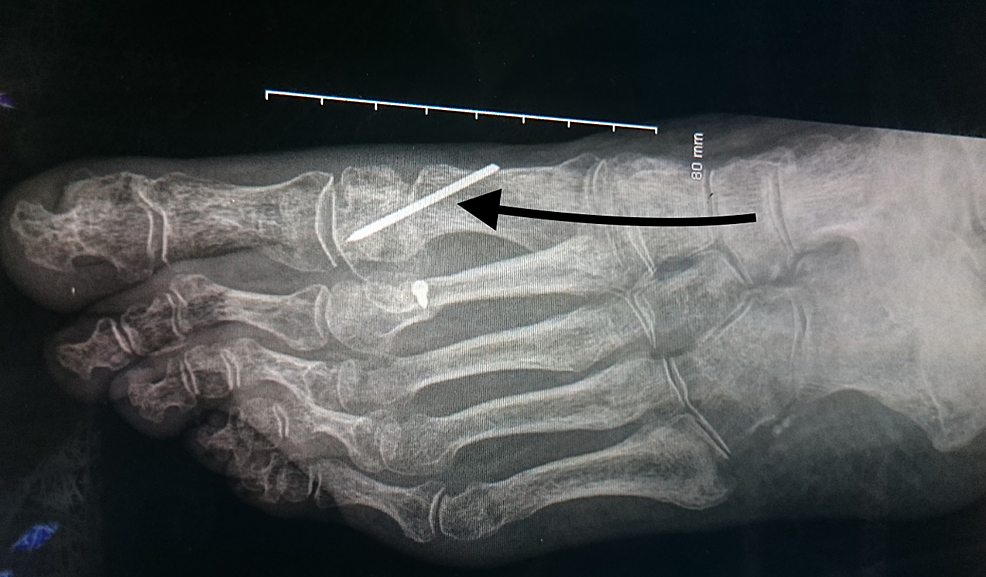 Cureus A Prospective Study of Distal Metatarsal Chevron Osteotomies