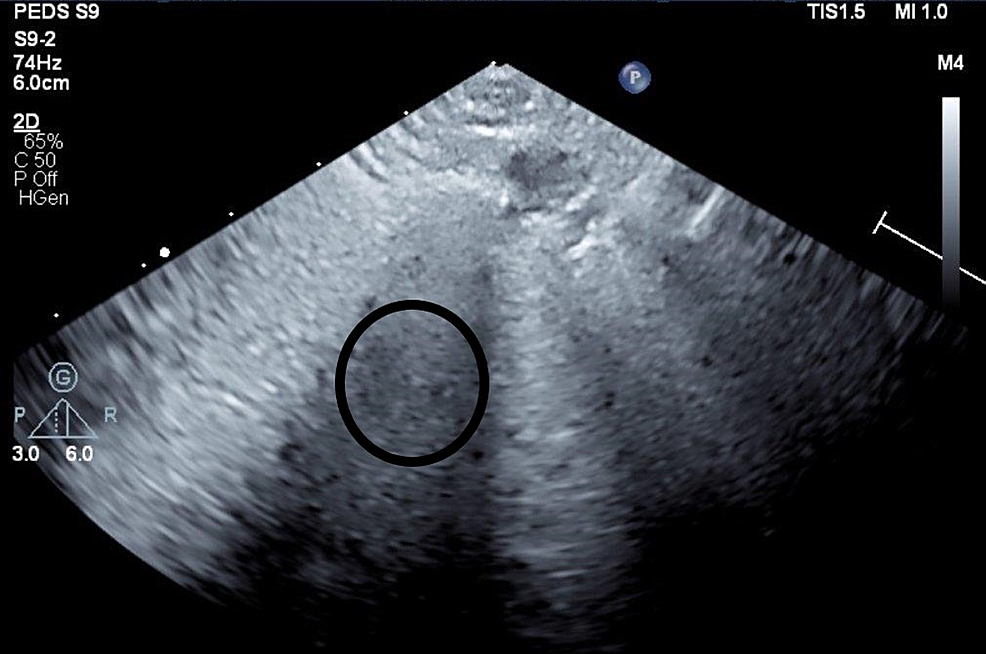 Lung-ultrasound-revealing-obliteration-of-A-lines,-confluence-of-B-lines-(bright-“comets”),-and-pulmonary-hepatization-(circled).