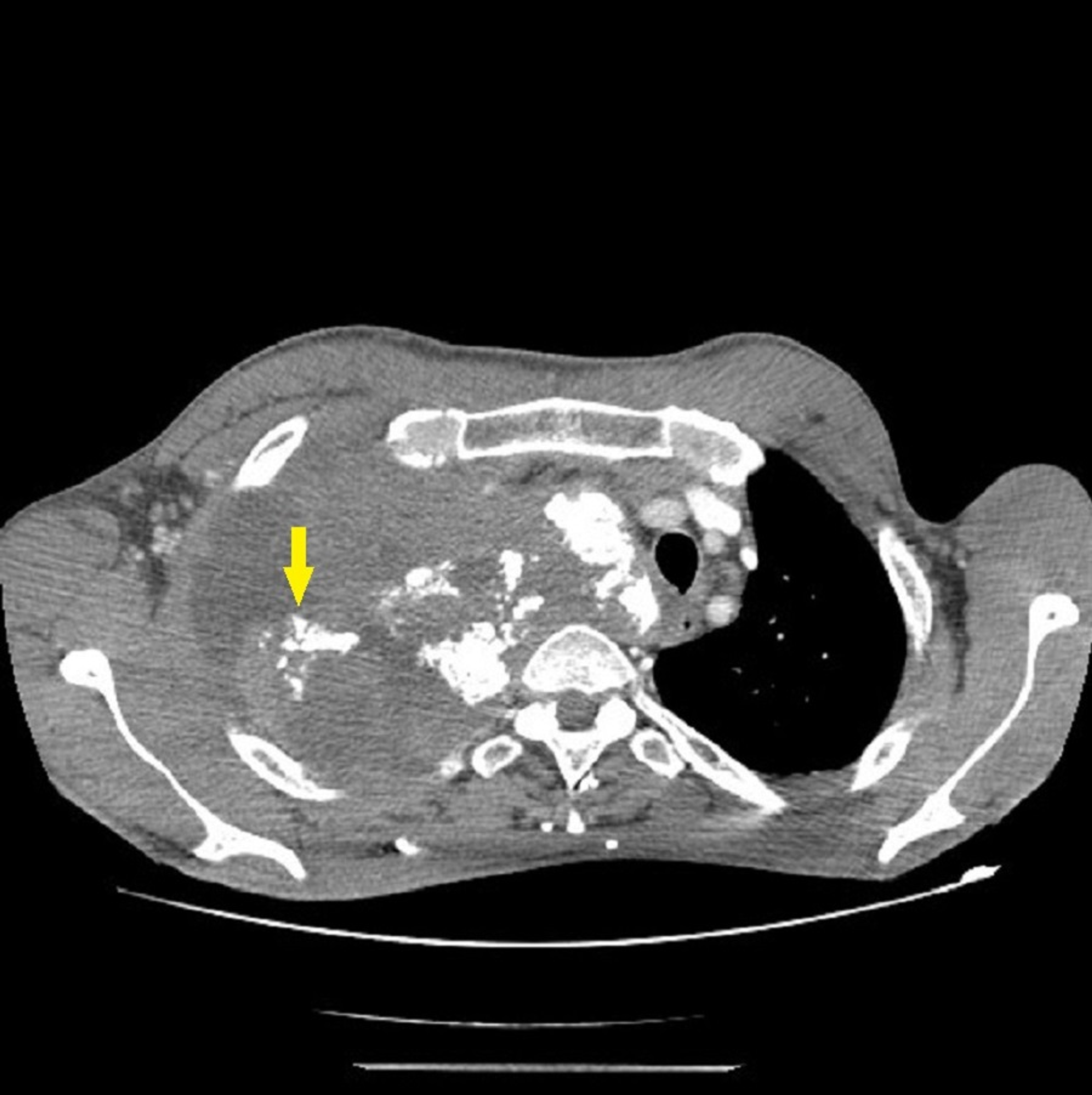 Cureus | A Rare Primary Pulmonary Chondrosarcoma