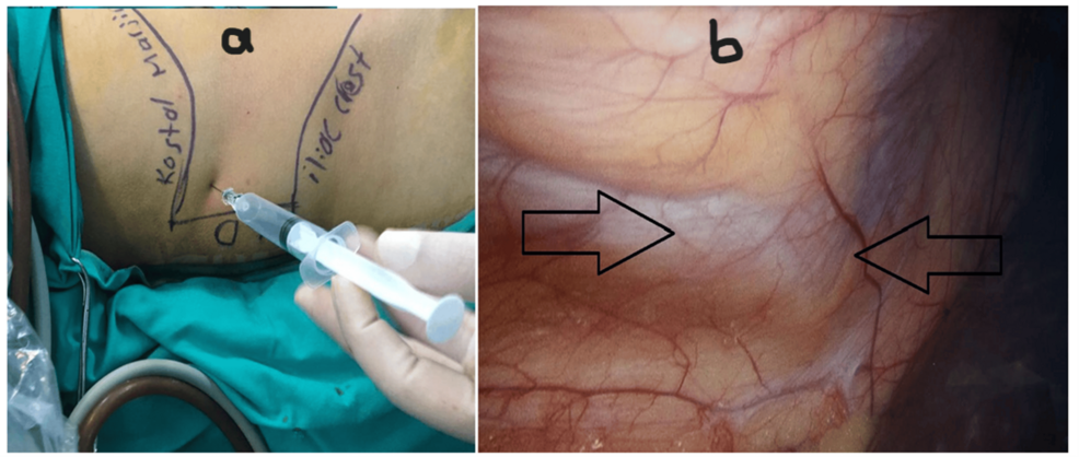 (a)-Triangle-of-Petit-and-(b)-laparoscopic-view-of-peritoneal-tenting-during-injection