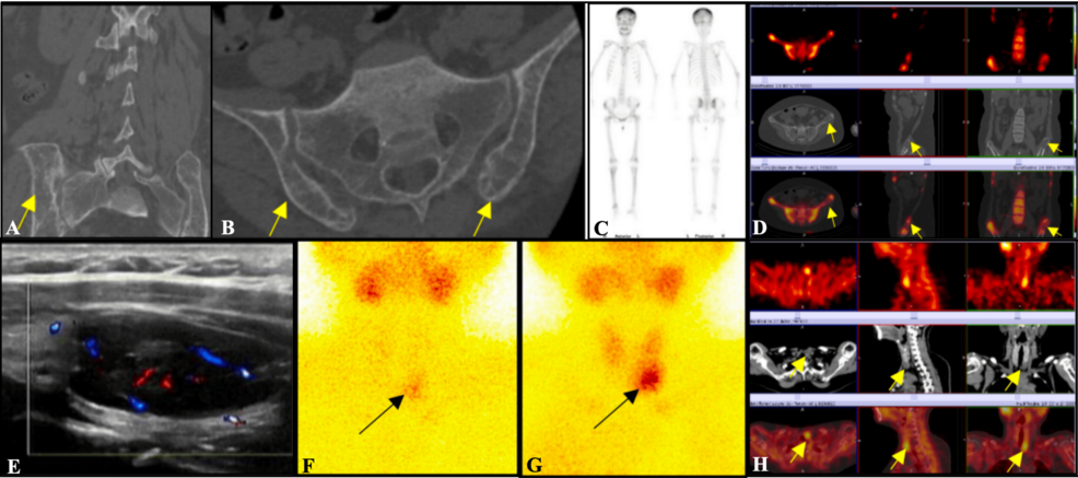 Imaging-findings-in-a-29-year-old-woman-with-primary-hyperparathyroidism-due-to-a-parathyroid-adenoma