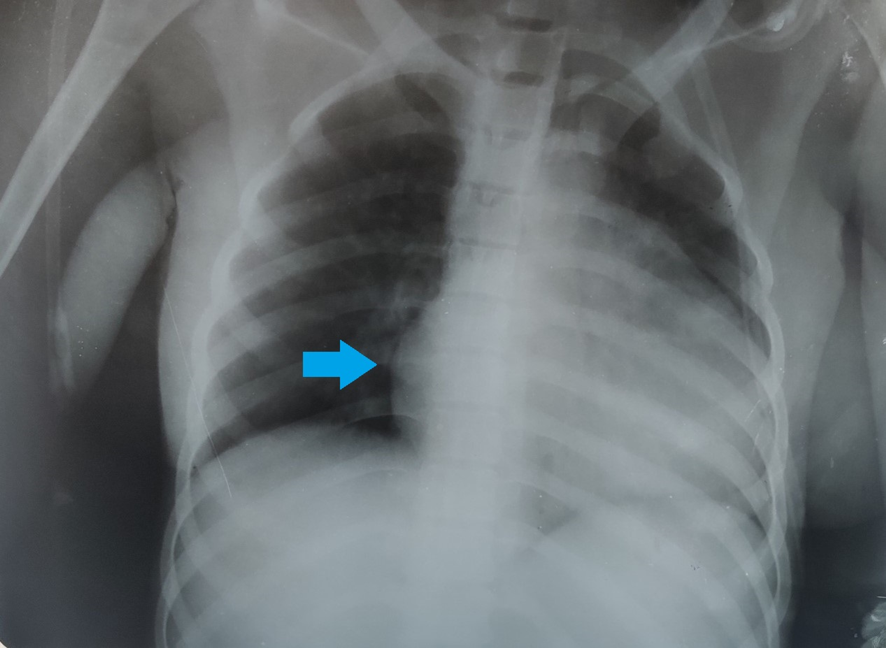 Cureus Systemic Lupus Erythematosus With Involvement in a