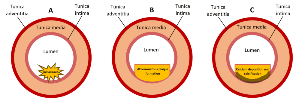 Cureus Review Examines Intravascular Lithotripsy for Calcified Peripheral Arterial Disease