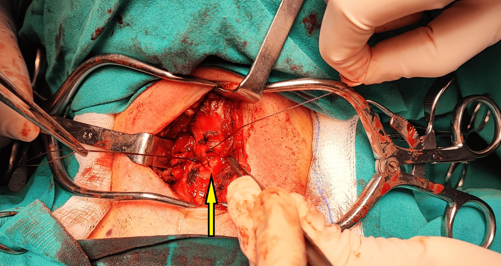 Intraoperative-view-after-primary-repair-of-the-anterior-tracheal-laceration-with-interrupted-absorbable-sutures-(arrow)