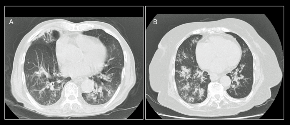 Chest-computed-tomography-(CT)-findings-at-admission