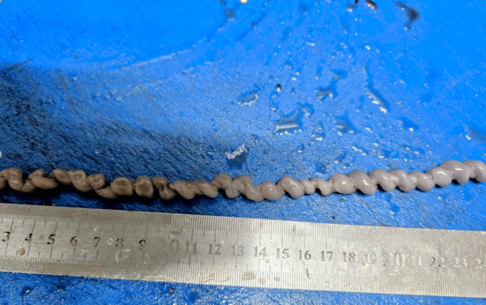 Case report links 19-week foetal demise to umbilical cord hypercoiling