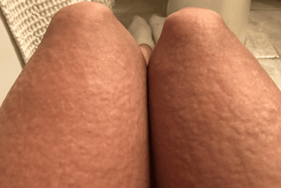 Excoriated-urticaria-affecting-the-legs-following-running