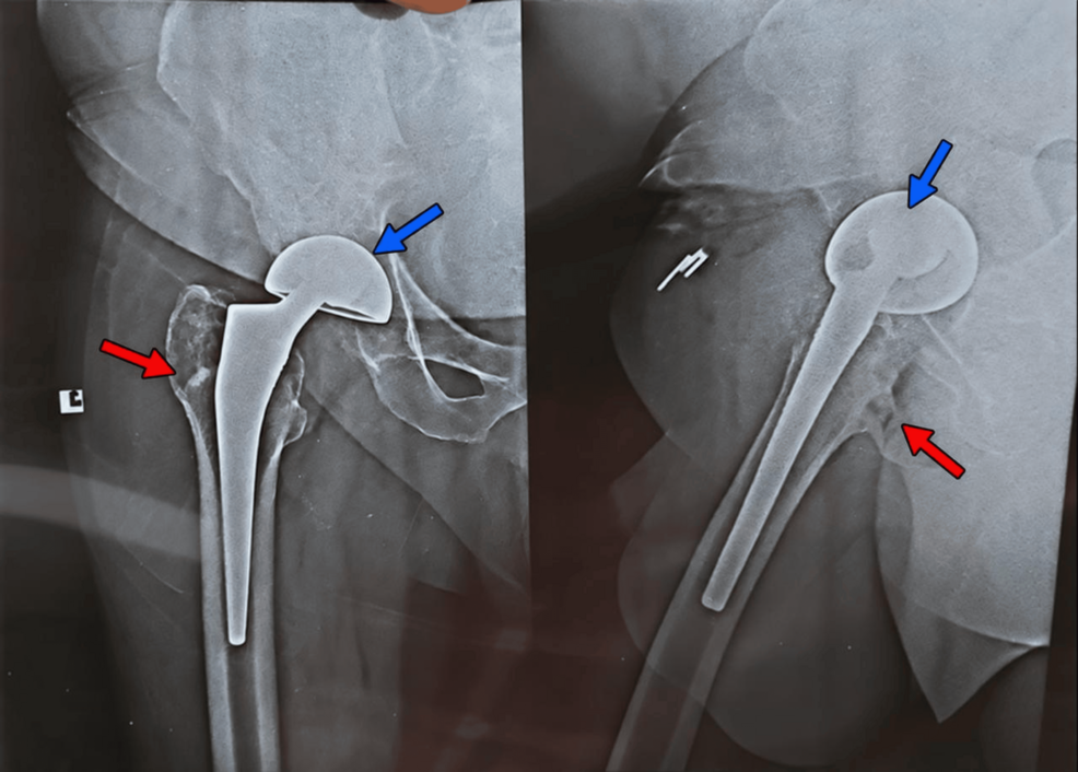 The image compares two hip X-rays with prosthetic implants. Both hips have artificial ball-and-socket joints replacing the