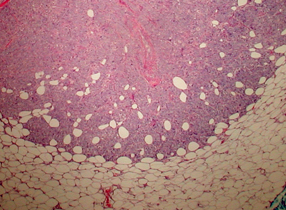 An Atypical Presentation of Soft Tissue Metastasis in a Patient With ...