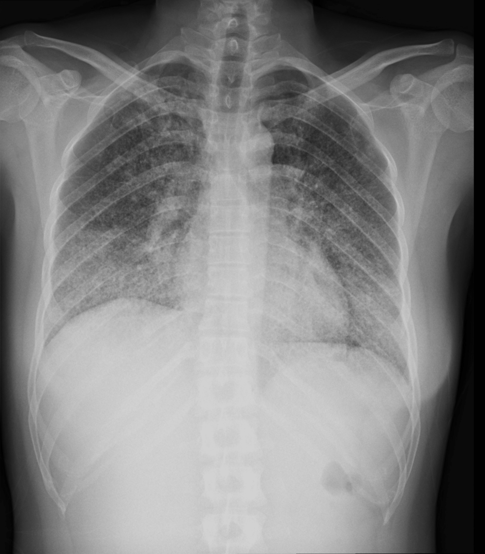 Chest-radiograph-showing-airspace-consolidation-in-both-lower-hemithoraces-and-areas-of-consolidation-in-the-upper-right-lobe