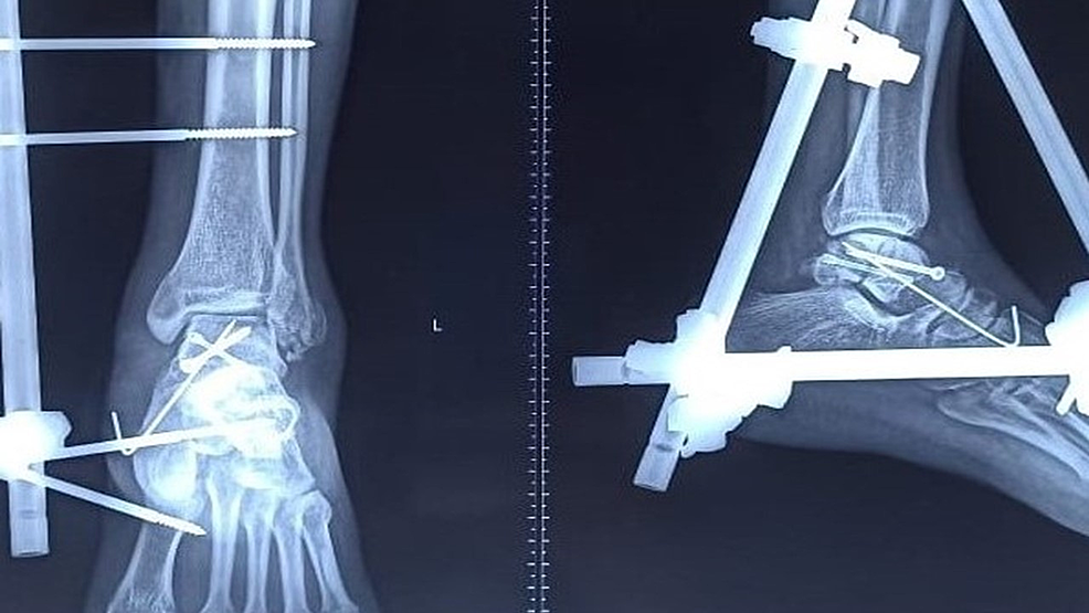 Cureus Talar Body Fracture With Closed PanTalar Dislocation