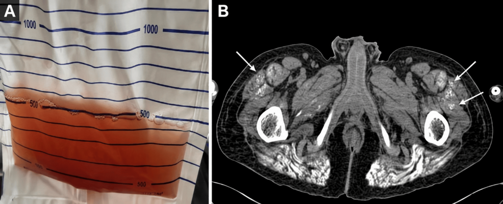 Case report: Amphetamines caused rhabdomyolysis in two men