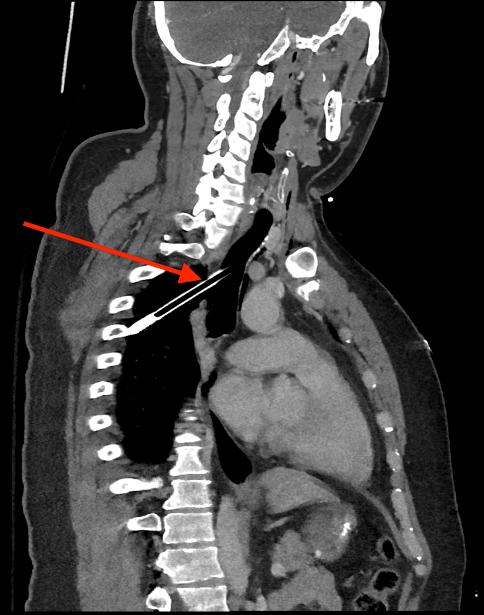 VV ECMO Enables Successful Repair of Penetrating Tracheal Trauma