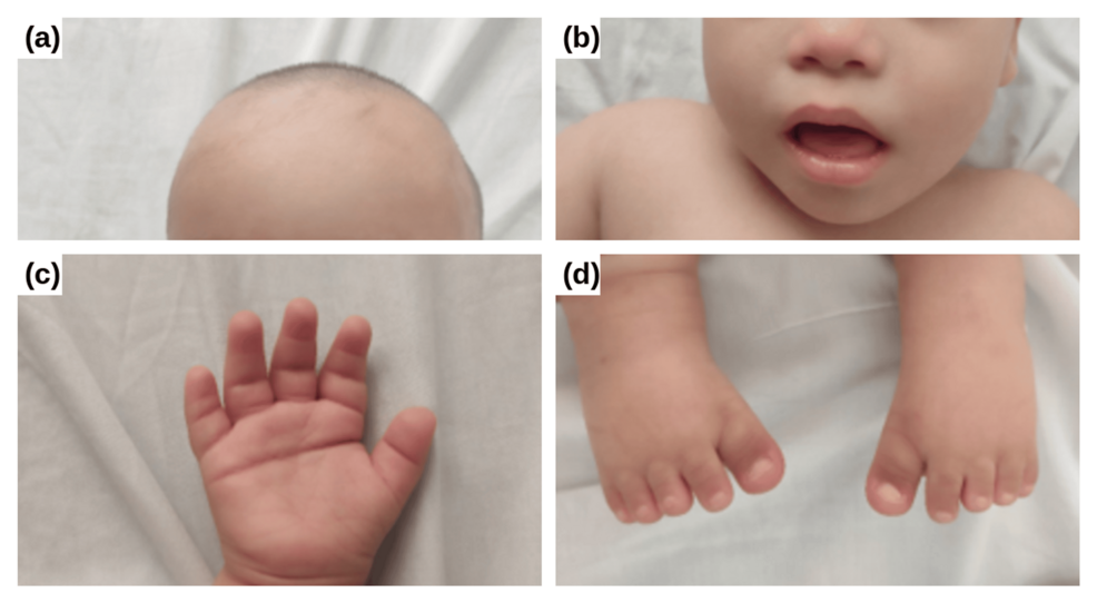 Four close-ups document a child’s head, lower face, hand, and feet. The forehead is broad, the nose is short, and the mouth