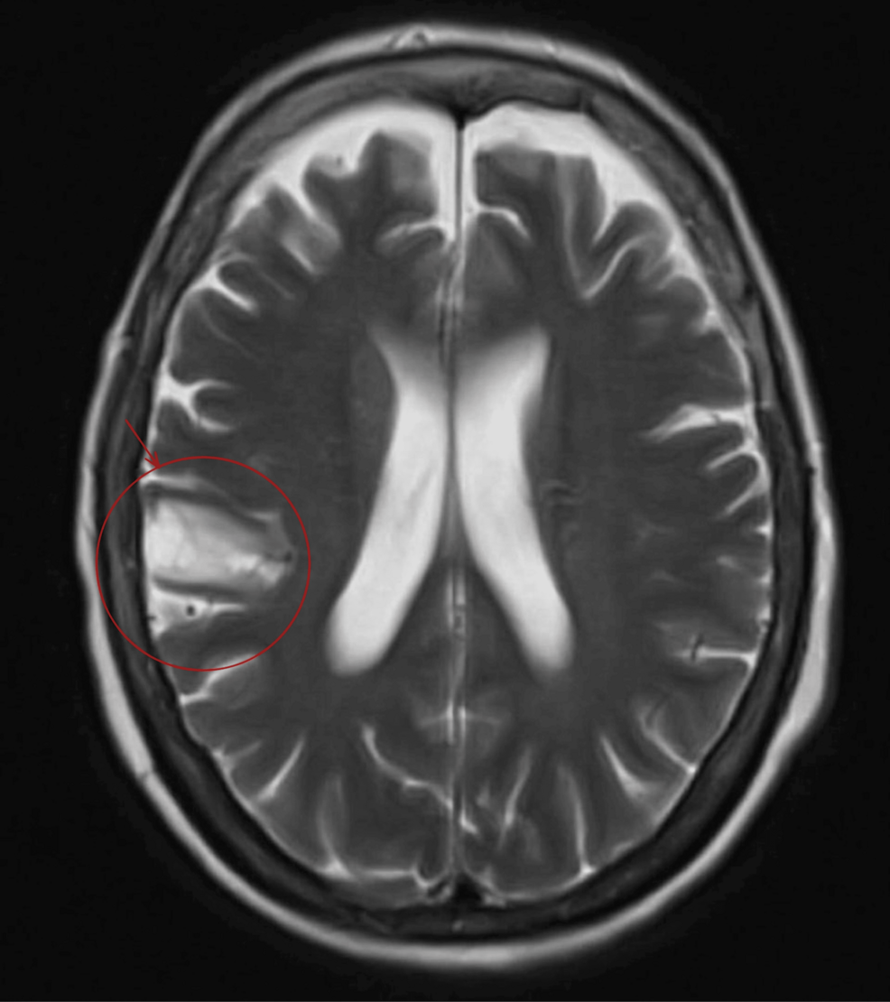 Posterior Reversible Encephalopathy Syndrome Associated with Graves' Disease: A Case Report