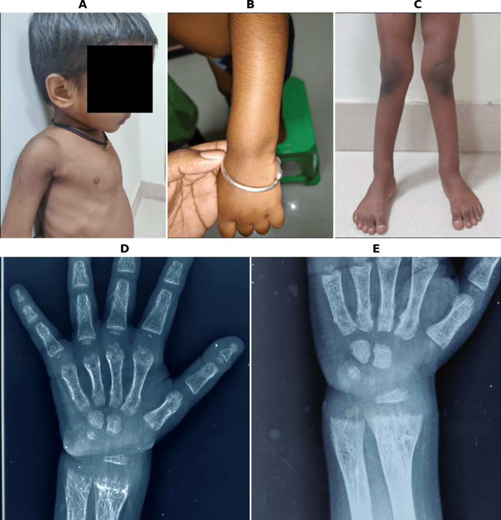 Two Pediatric Cases of Distal Renal Tubular Acidosis Detailed