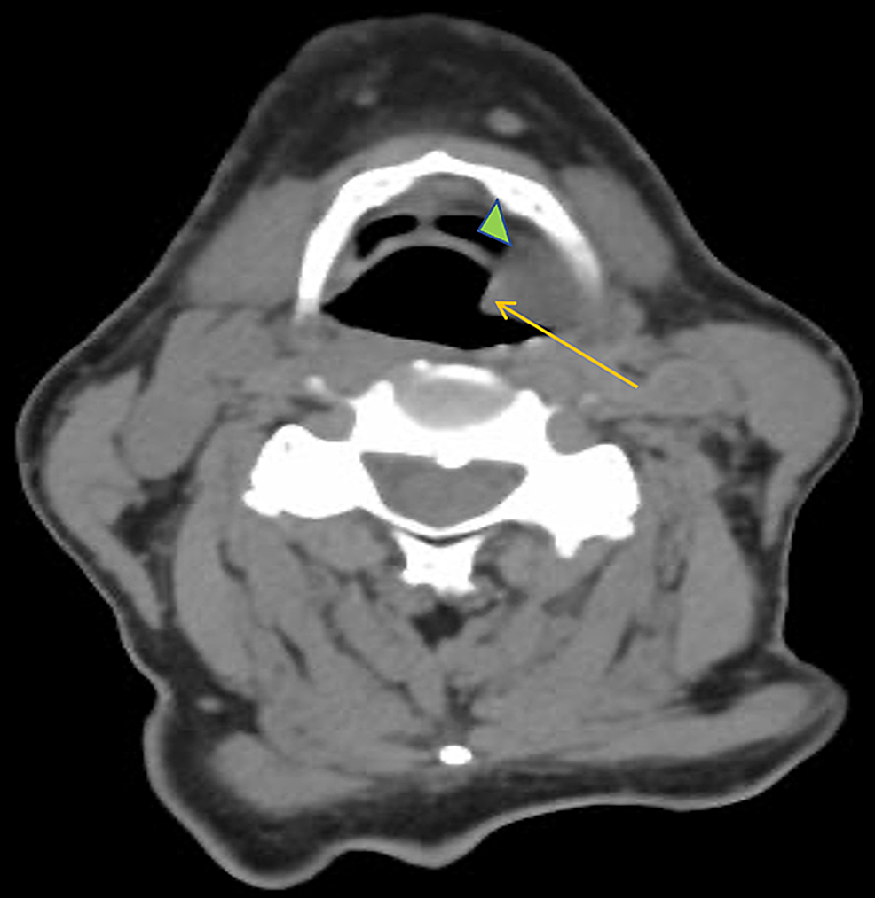 Cureus | Cardiac Metastasis in a Living Patient With Laryngeal Squamous ...