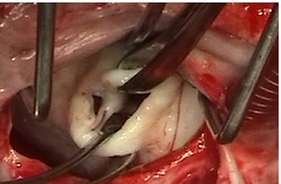 Cureus | Mitral Valve Replacement with Total Chordal Preservation: The