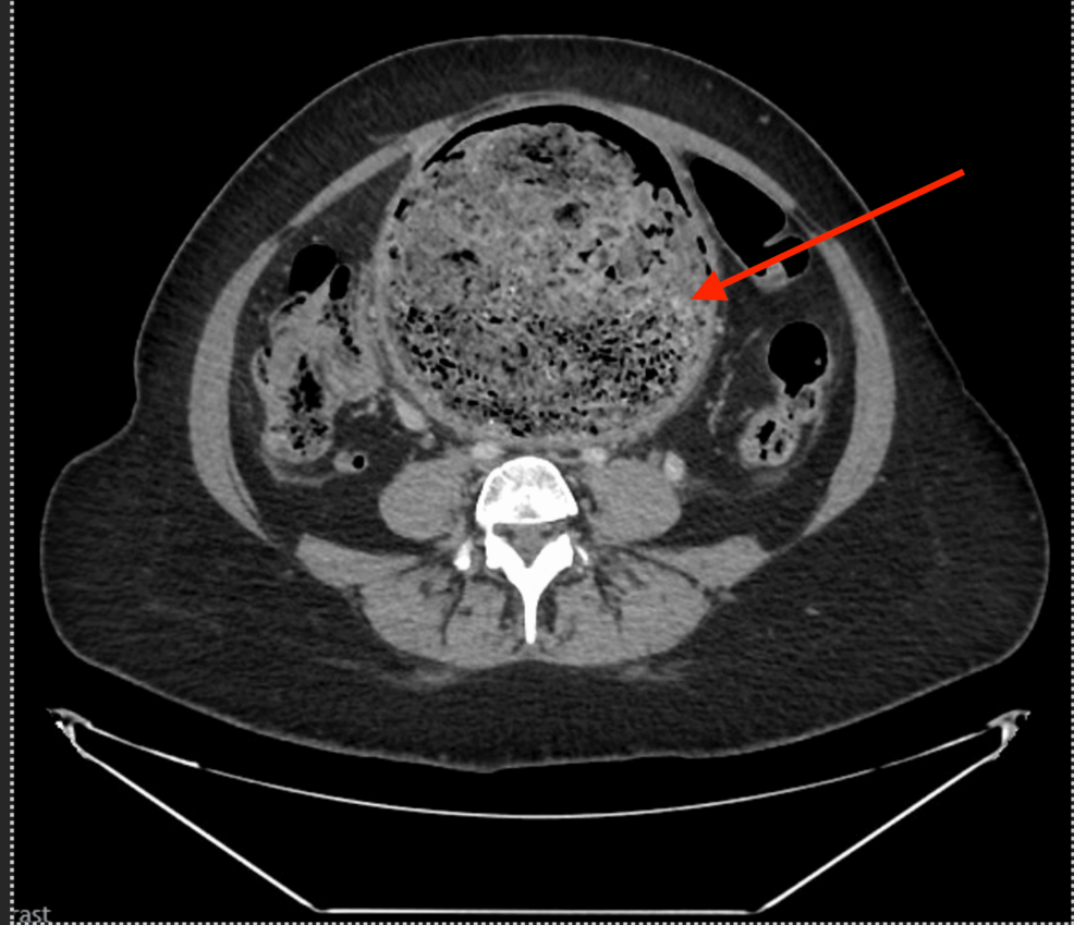 CT-of-the-abdomen-and-pelvis-with-contrast;-the-red-arrow-shows-a-fecal-mass-occupying-the-rectum,-extending-proximally