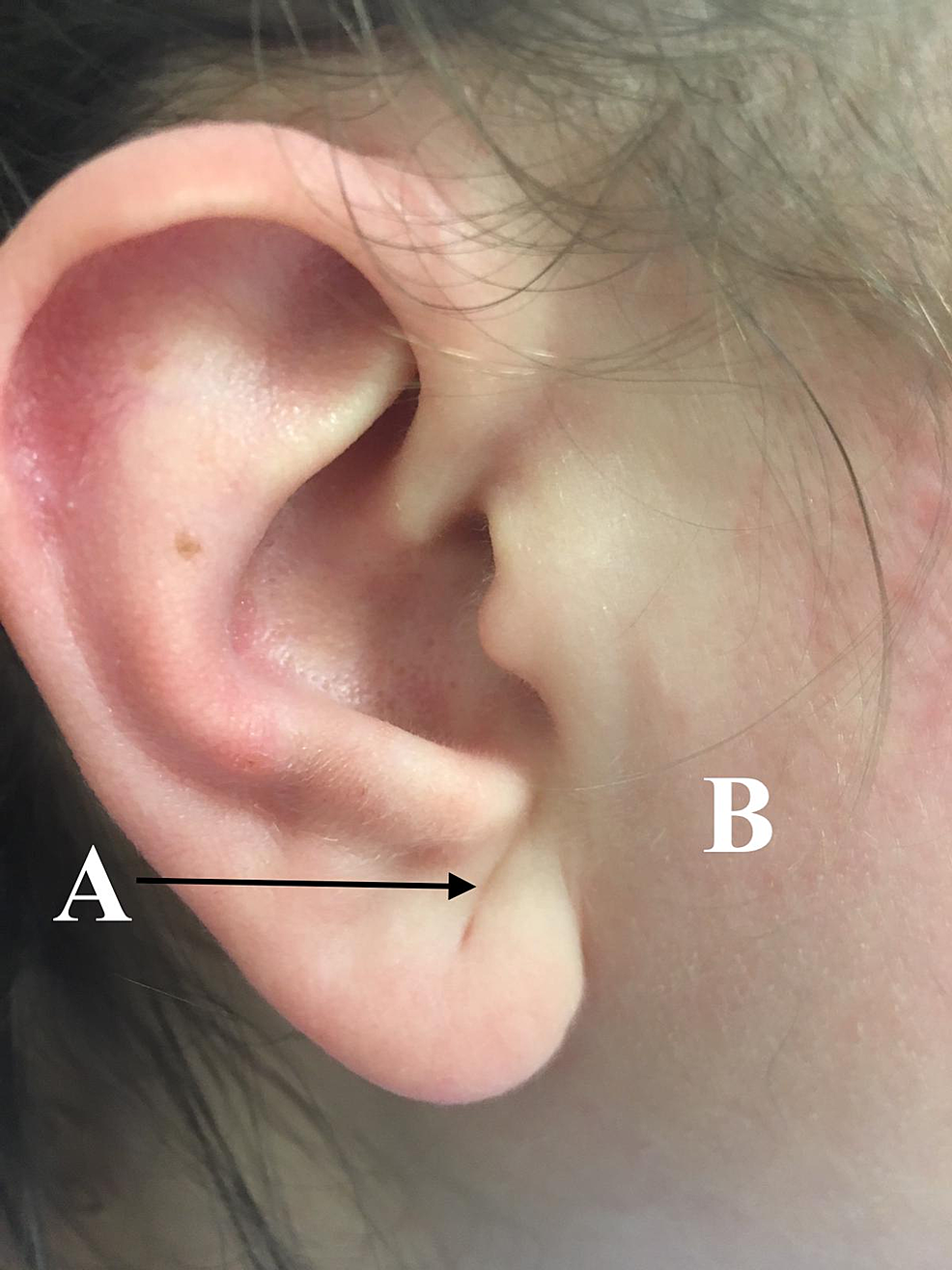 Diagonal-earlobe-crease-and-PCOS.