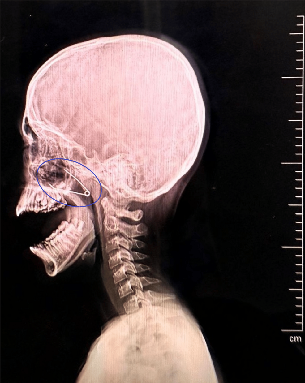 Lateral-view-x-ray-with-mouth-open-showing-a-radio-opaque-foreign-body-consistent-with-a-safety-pin;-the-sharp-pointed-end-is-in-the-nasopharynx-and-the-hinge-projecting-in-nasopharyngeal-oropharyngeal-junction