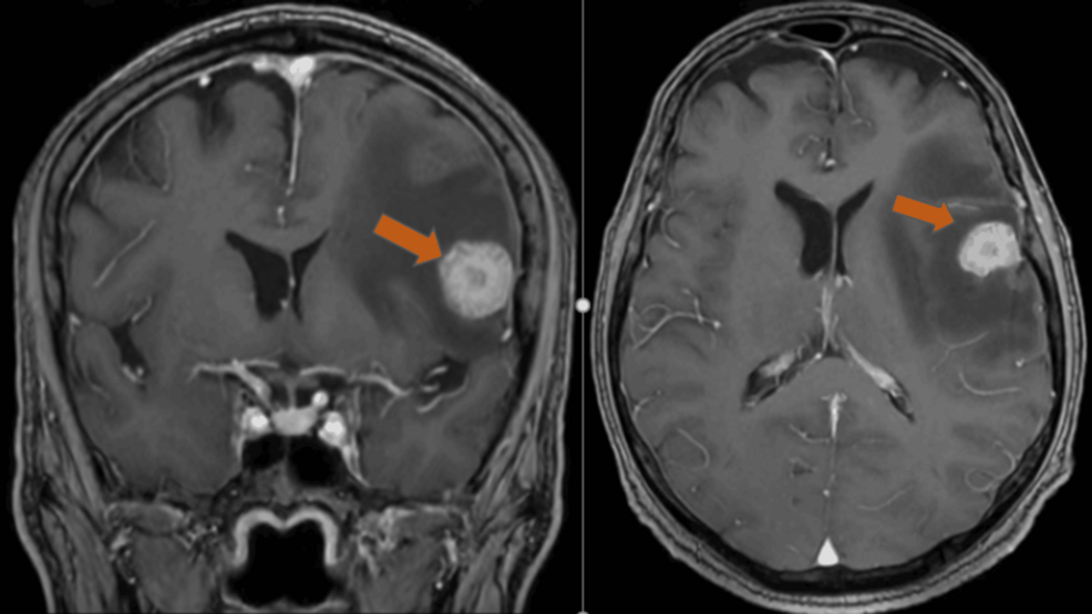 Contrast-enhanced-T1-weighted-brain-MRI-coronal-(left)-and-axial-(right)-views-demonstrating-a-21-mm-intra-axial-cortico-subc
