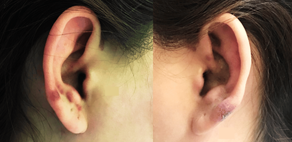 Atypical Presentation of Systemic Lupus Erythematosus Presenting as Earlobe Purpura and Severe Thrombocytopenia