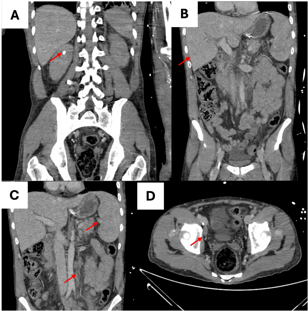 Thoracoabdominal-computed-tomography-findings