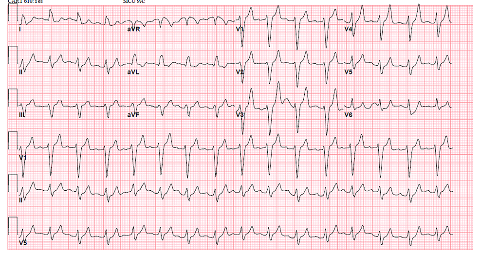 Cureus | Transient Left Bundle Branch Block in the Setting of Hyperkalemia