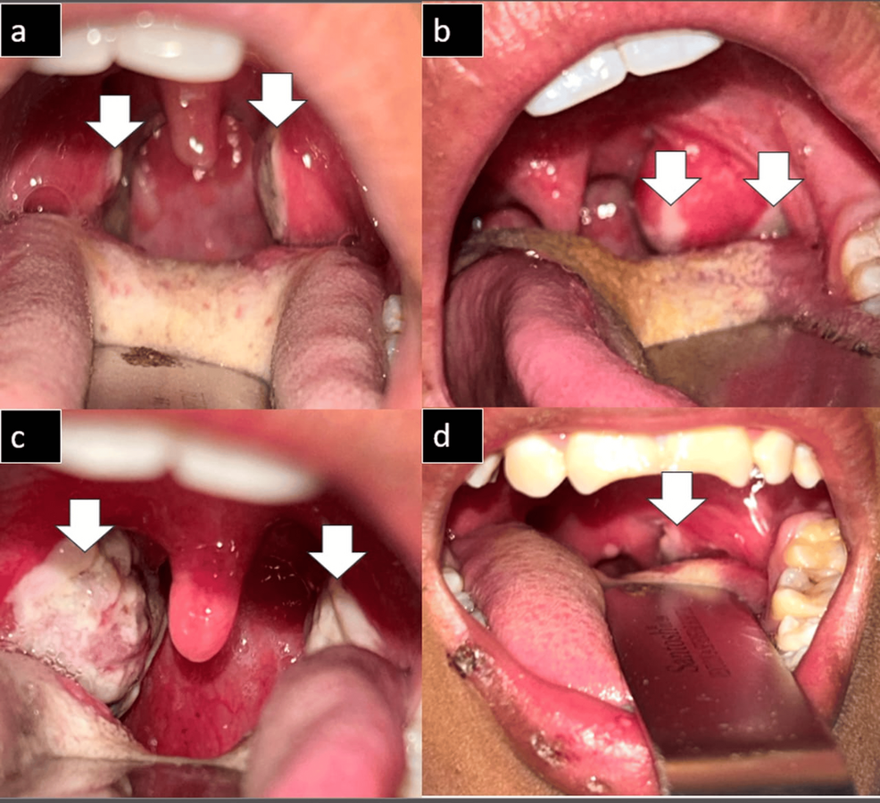 (-a-d)-Clinical-presentation-of-diphtheria-cases-present-in-our-study