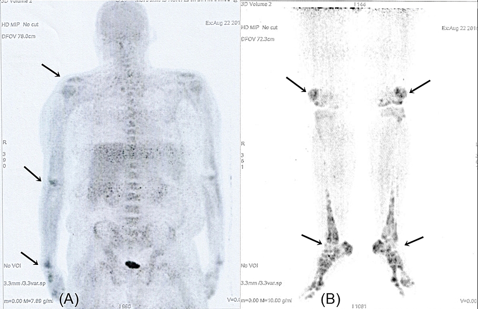 Whole-body-positron-emission-tomography-scan-showed-increased-uptake-in-the-major-articular-areas-(arrows).