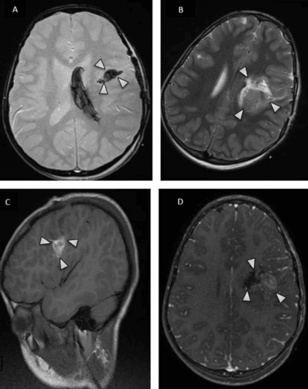 Brain-magnetic-resonance-imaging-(MRI)-performed-on-the-third-postoperative-day. Brain-magnetic-resonance-imaging-(MRI)-performed-on-the-third-postoperative-day.