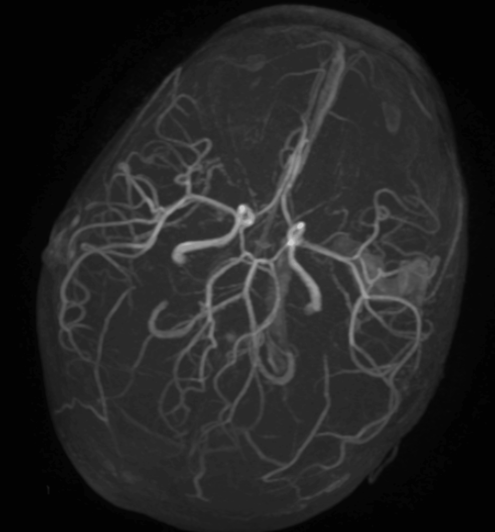 Three-dimensional-time-of-flight-magnetic-resonance-angiography-of-the-intracranial-arteries Three-dimensional-time-of-flight-magnetic-resonance-angiography-of-the-intracranial-arteries