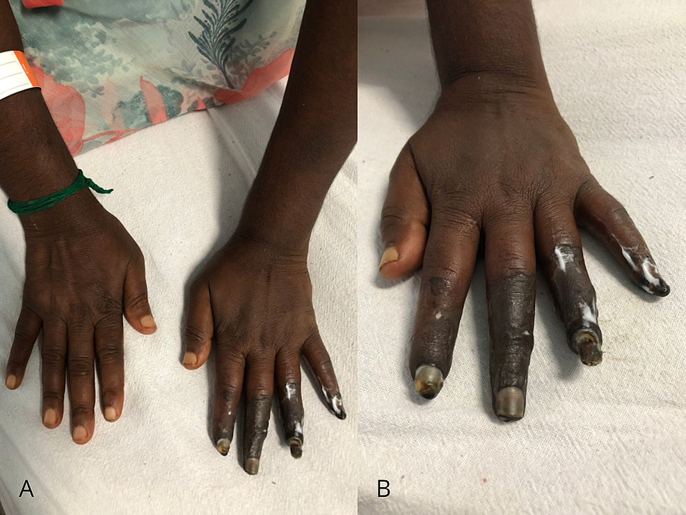 Diagnosis Of Undifferentiated Connective Tissue Disease In A Patient ...