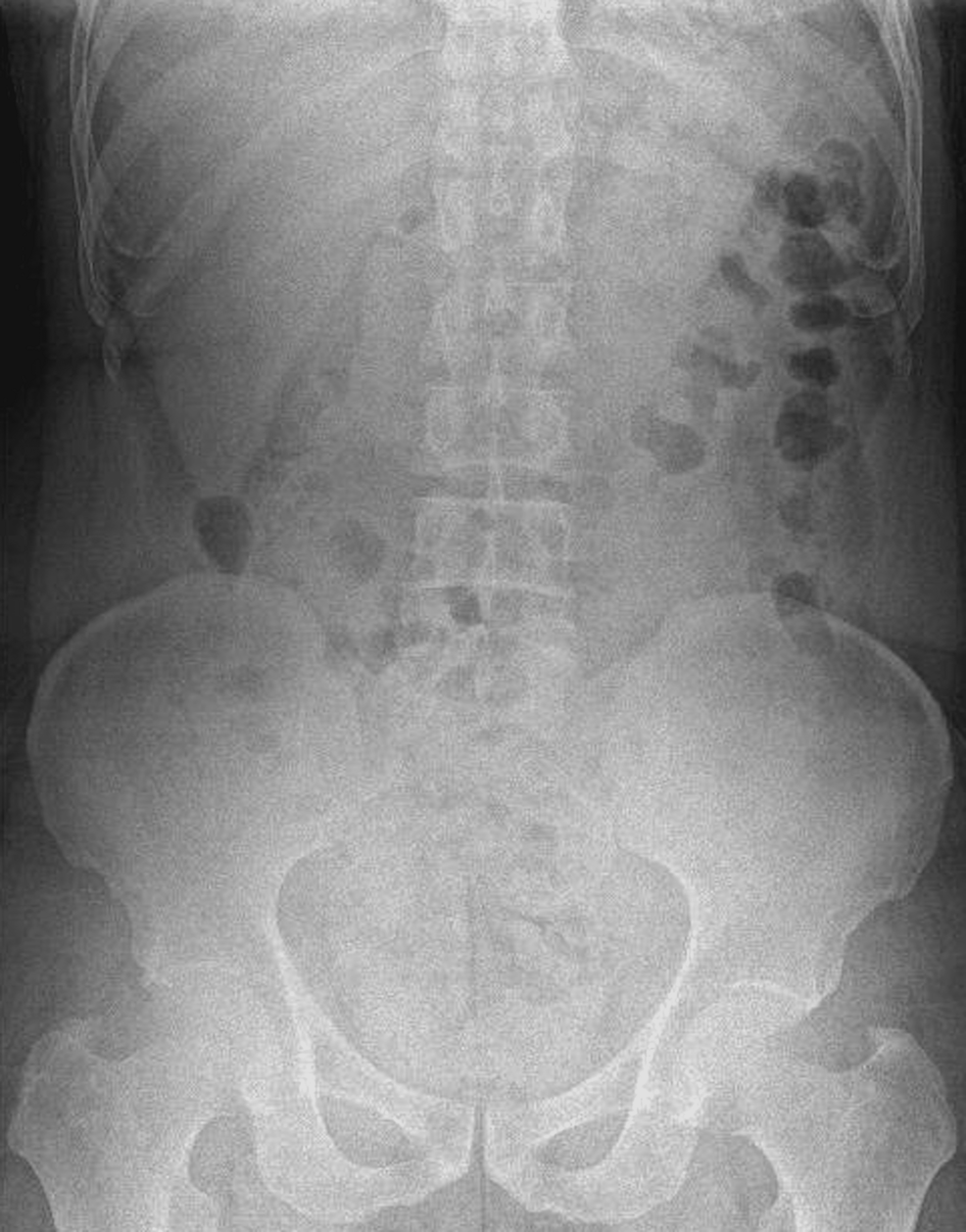 Fishbone Ingestion Causing Cecal Perforation: A Case Report