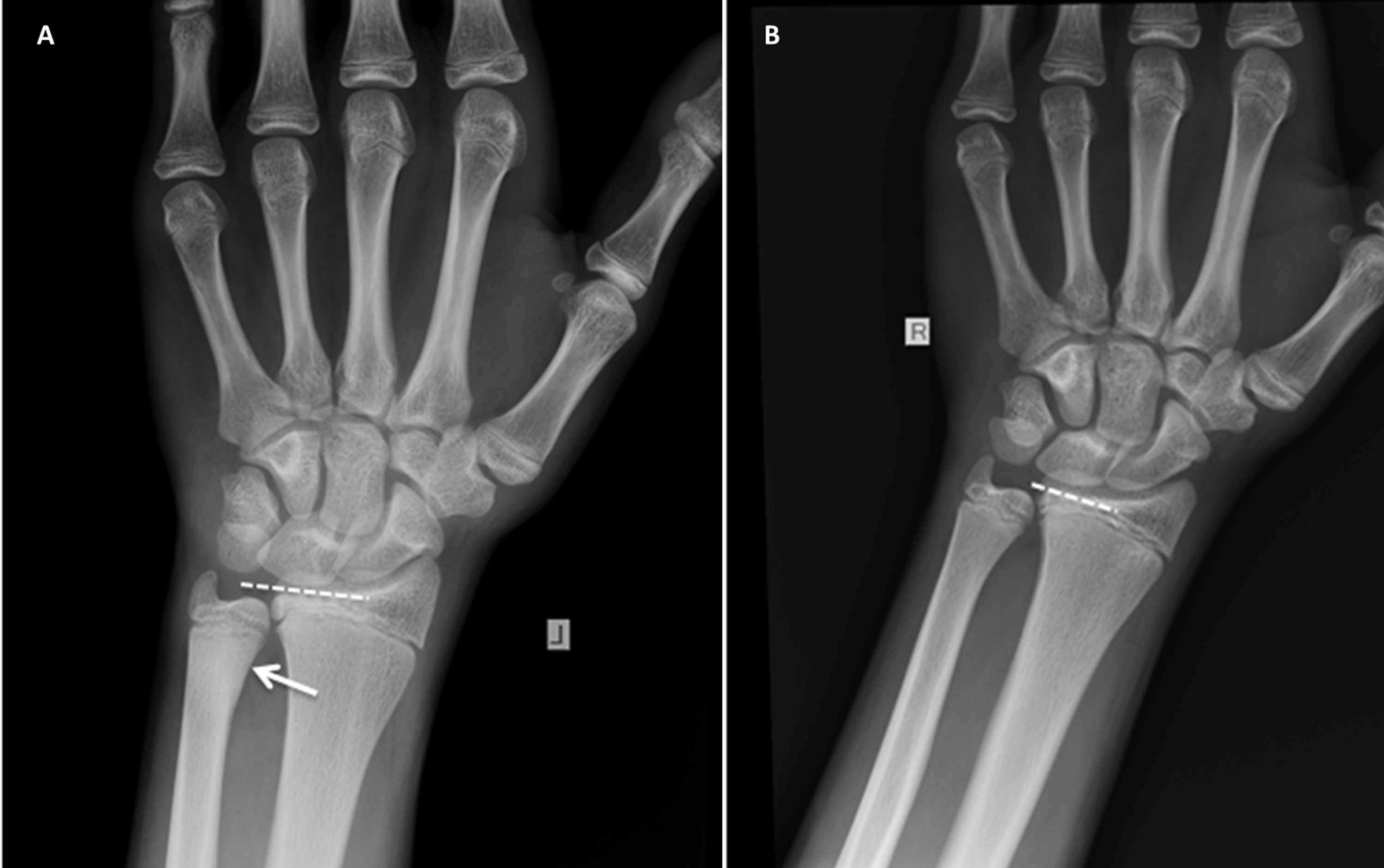 buckle fracture wrist growth plate