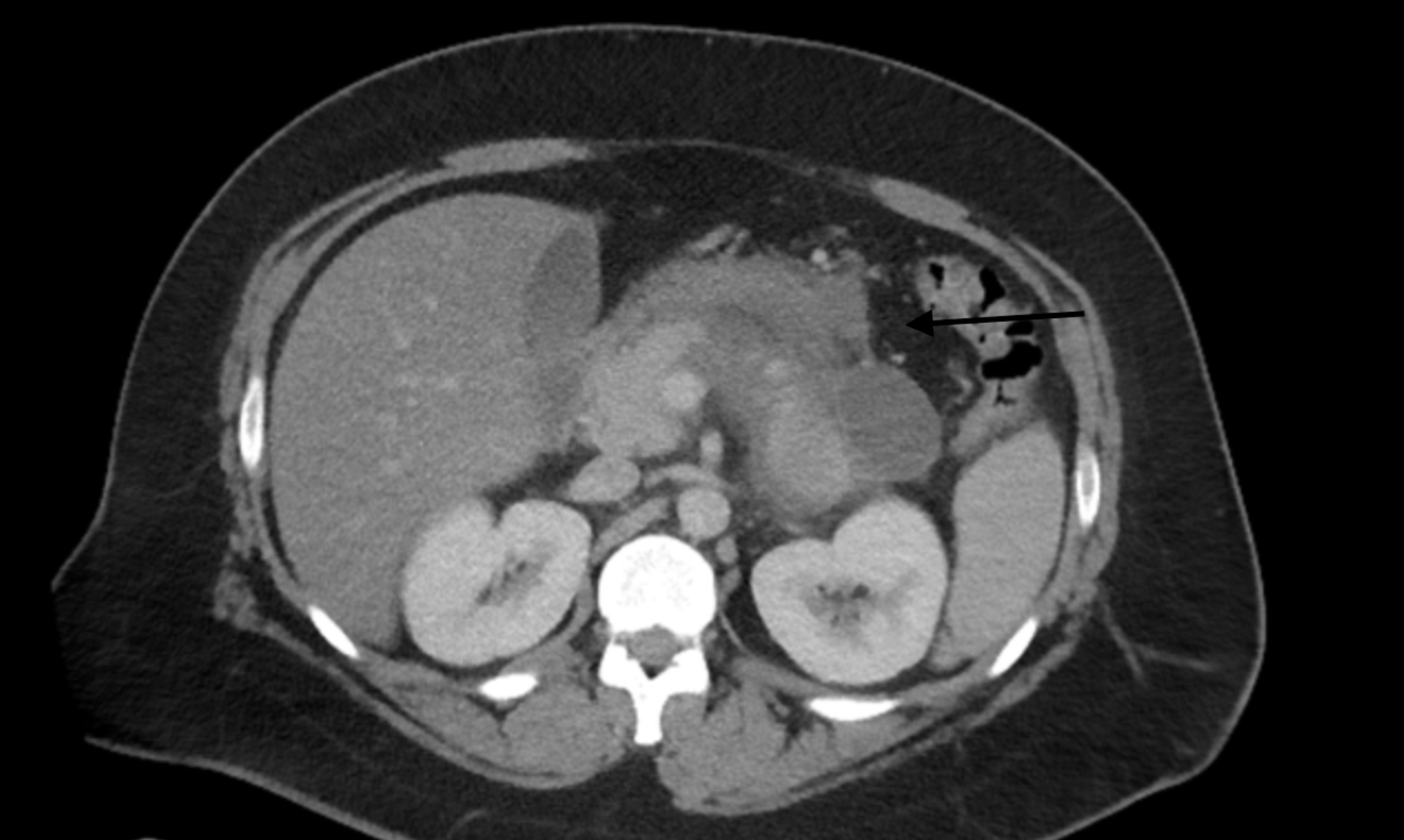 Cureus Acute Pancreatitis Induced Splenic Vein Thrombosis | Hot Sex Picture