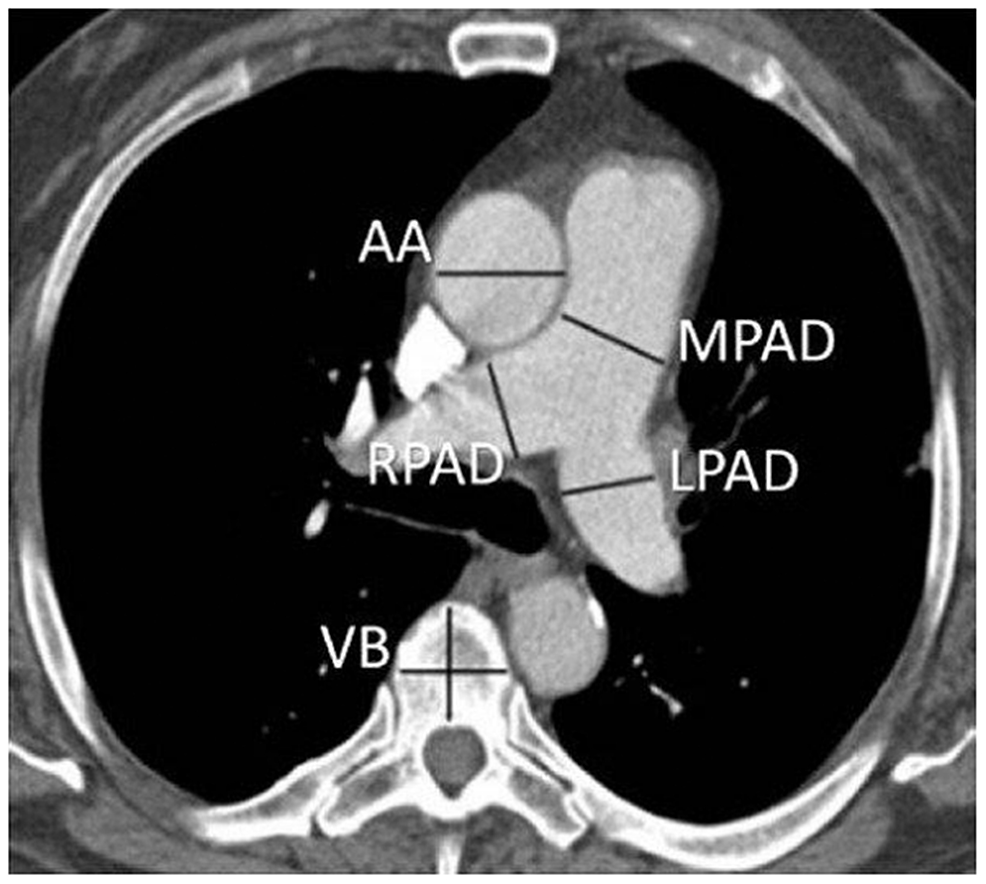 Cureus A Comparison Of The Pulmonary Valve Main Pulmonary Artery And Branch Pulmonary Artery 3473
