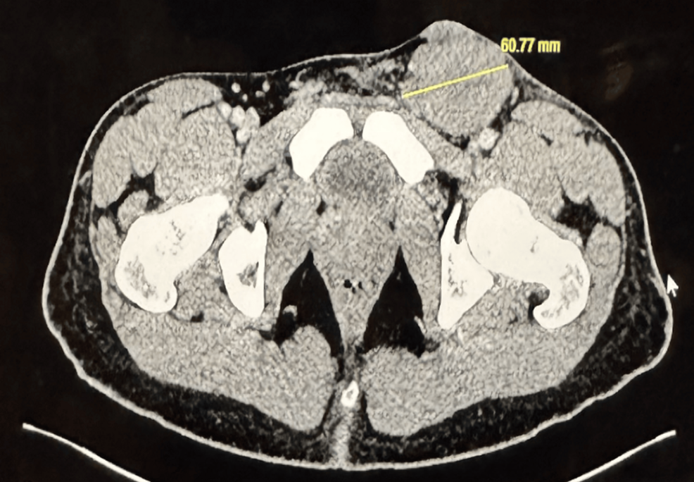 DLBCL Diagnosed in 19-Year-Old Male, Cureus Reported