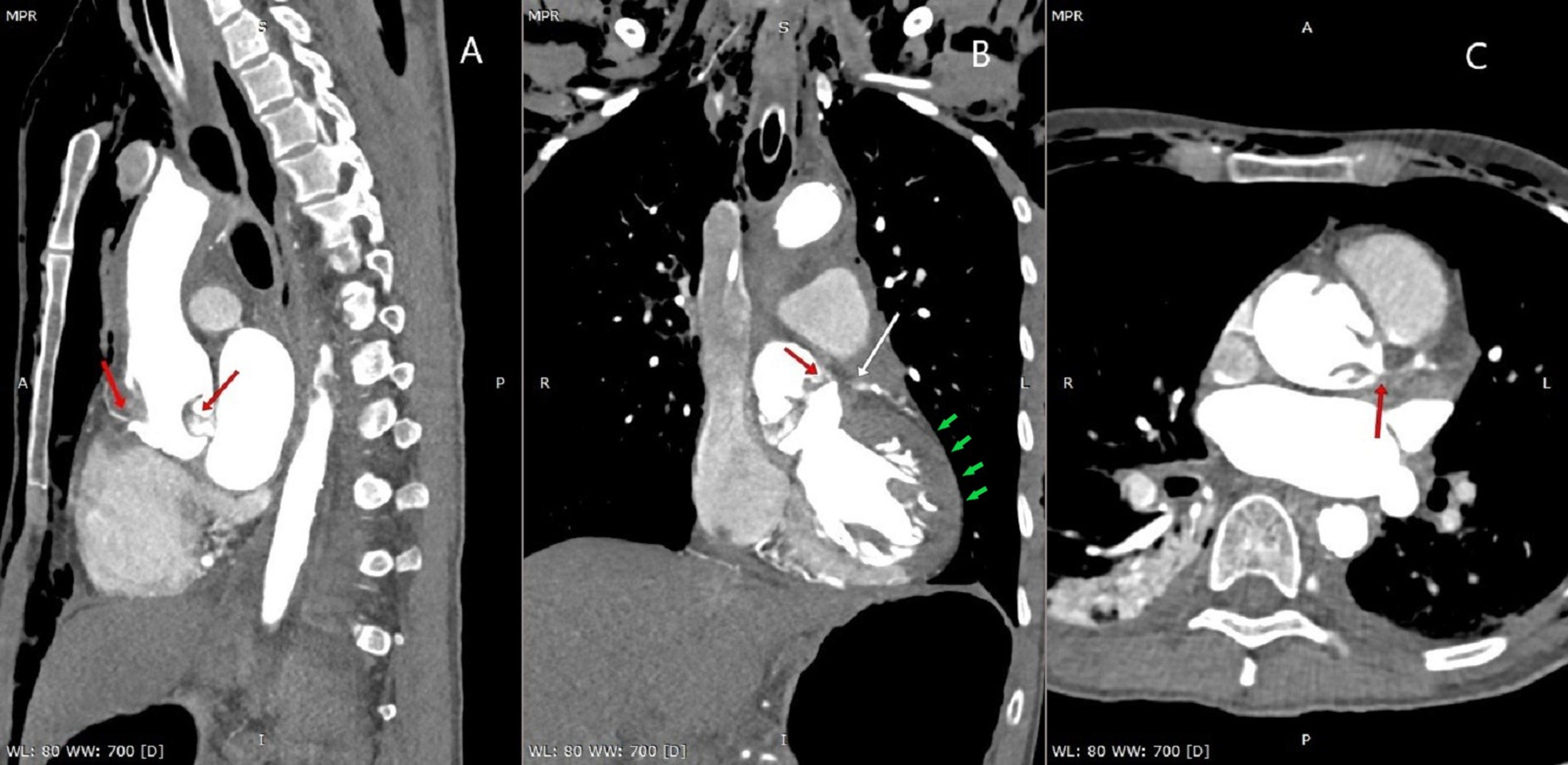 Cureus Aortic Dissection With Complete Occlusion of Left Main