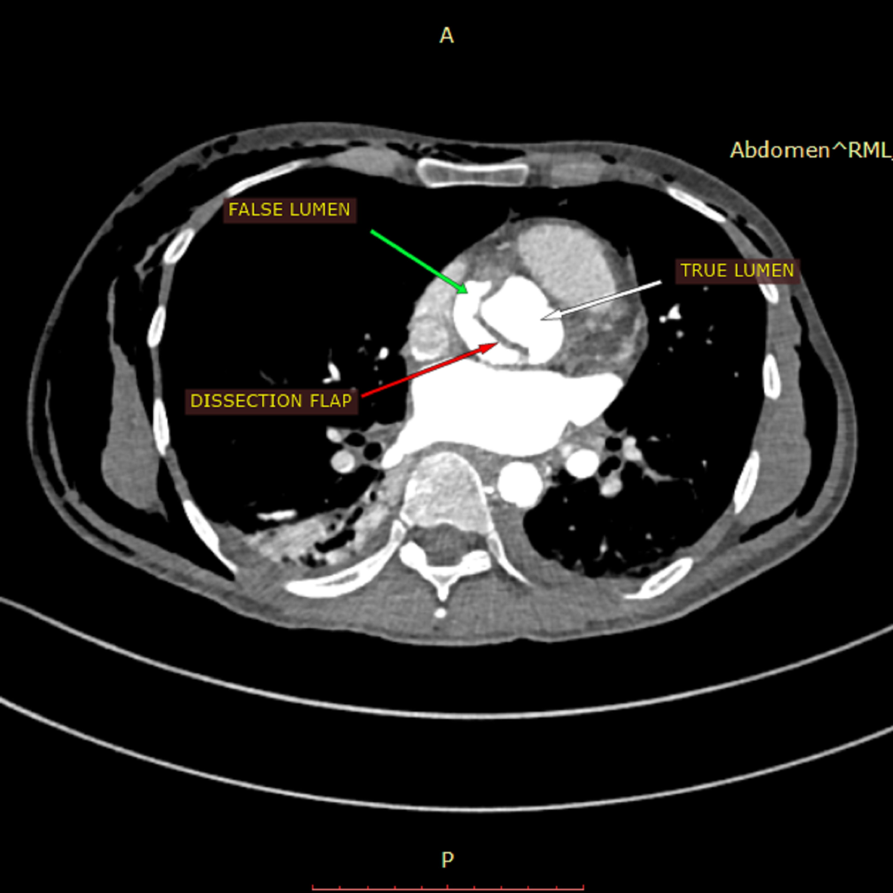 Cureus | Aortic Dissection With Complete Occlusion Of Left Main ...