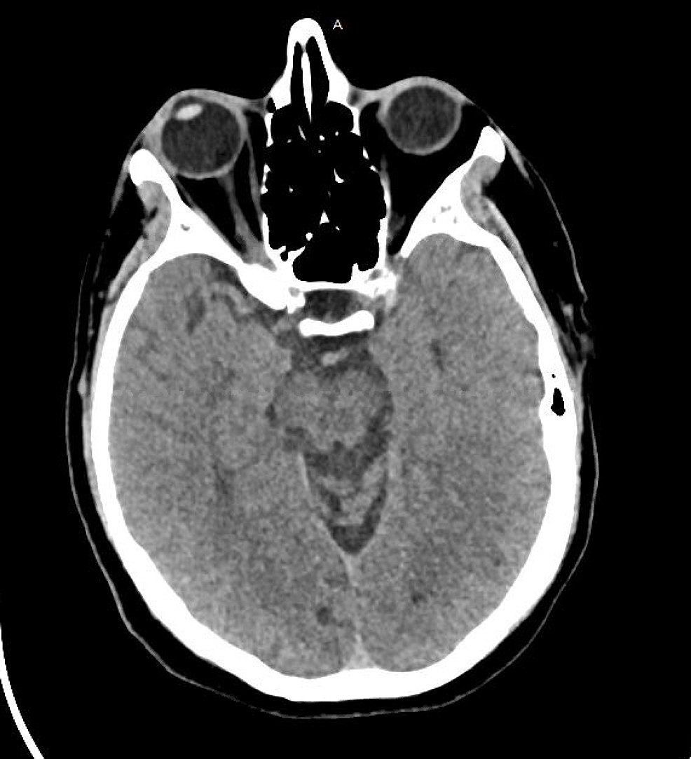 Initial-CT-of-the-head-without-intravenous-contrast:-no-intracranial-mass,-mass-effect,-midline-shift,-or-herniation-is-present.-No-acute-intracranial-hemorrhage-is-present.-No-findings-of-an-acute-territorial-infarction-are-present.-No-extra-axial-collection-is-present.-The-ventricular-system-is-normal-in-size.-Brain-parenchymal-attenuation-is-normal.