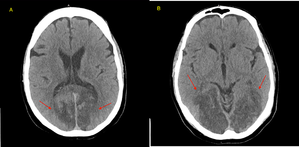 Subsequent-CT-of-the-head-without-IV-contrast-on-day-1-showed-ventricles-and-sulci-are-normal.-No-extra-axial-fluid-collection-or-subarachnoid-hemorrhage-is-seen.-There-is-no-intraparenchymal-hematoma-or-mass.-There-is-loss-of-gray-white-differentiation-of-the-right-and-left-occipital-lobes-(red-arrows-in-A-and-B).-There-is-loss-of-gray-white-differentiation-of-the-cerebellum-on-the-right-and-left,-where-multiple-large-acute-appearing-infarcts-are-apparent.-Dural-sinuses-are-normal-in-attenuation.-Osseous-structures-are-unremarkable.-No-air-fluid-level-is-noted.