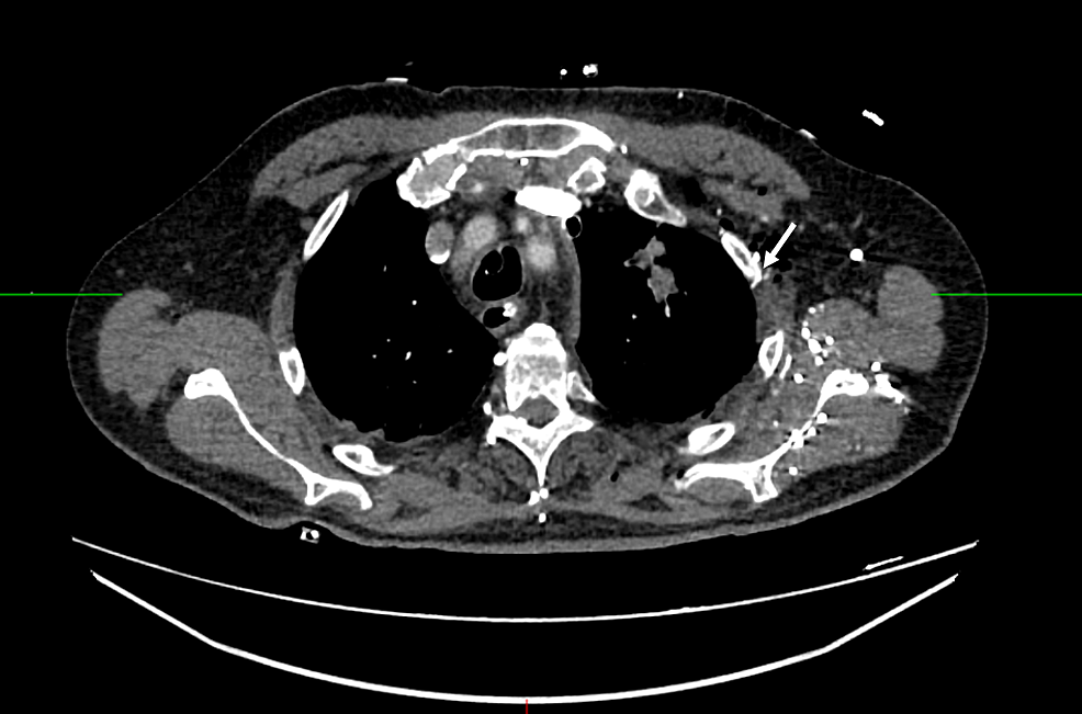 Cureus Massive Tension Hemothorax After Pacemaker Implantation