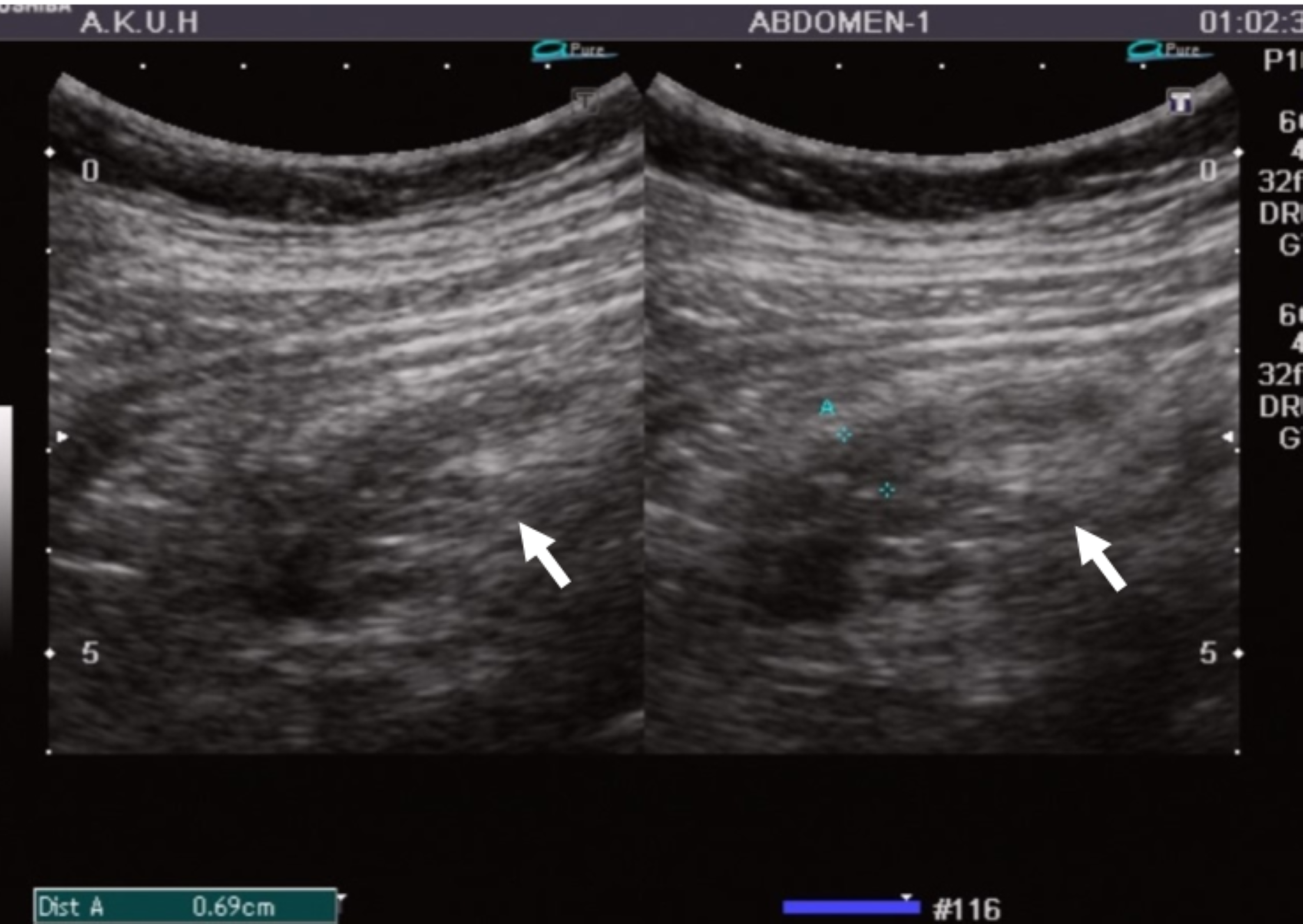 appendicolith ultrasound
